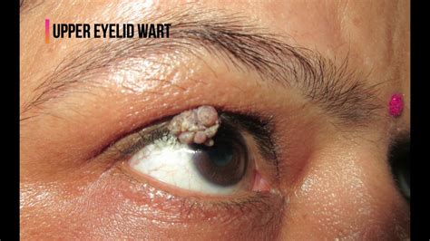 Dr Bhagyesh B Pore Indore Eyelid Warts Papilloma Removal Youtube
