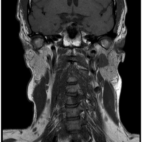 Magnetic Resonance Imaging Showing The Left Parotid Gland Mass In The