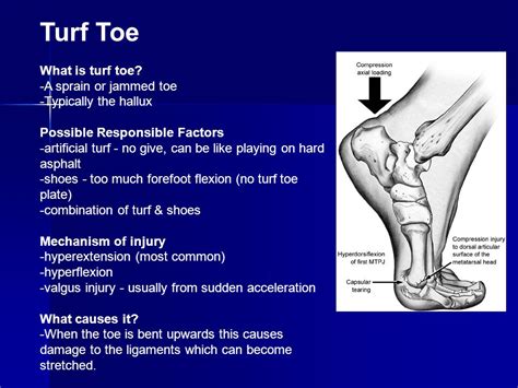 Turf Toe Mechanism Of Injury Turf Toe Great Toe Hallux Big Toe Injury
