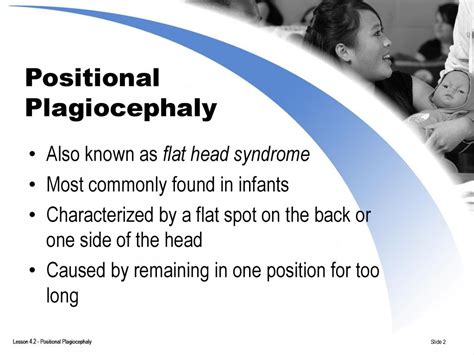 Positional Plagiocephaly Ppt Download