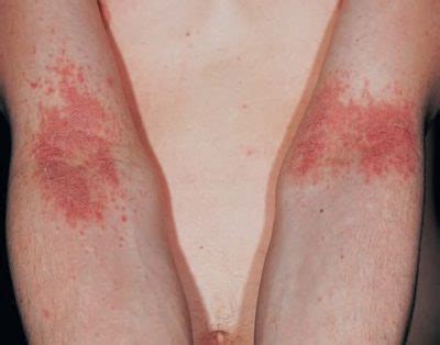 Dermatita Atopica Cauze Simptome Preventie Tratament Hot Sex