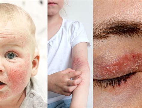 Dermatite Atopica E Disturbi Del Sonno Derma Point