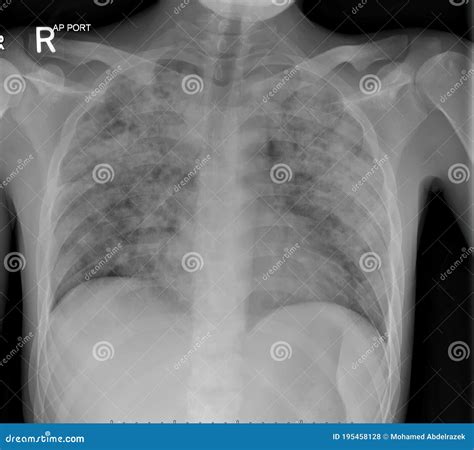 Active Tuberculosis Chest X Ray