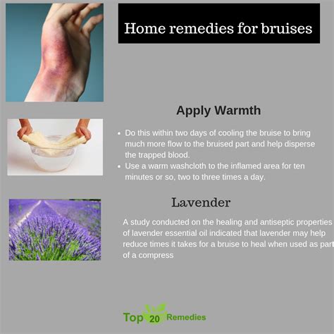 Bruises Treatment Home Remedy Top 20 Home Remedies