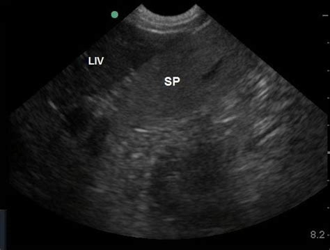 Evaluating The Liver With Ultrasound Diffuse Hepatopathies