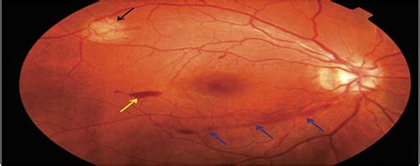 Novel Preretinal Hair Pinlike Vessel In Retinal Astrocytic Retinal Cases And Brief Reports