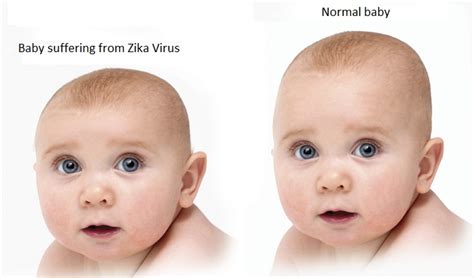 What we know about the zika virus and pregnancy is changing rapidly. October 4, 2016: Study Finds Zika Infects Neural Cells ...