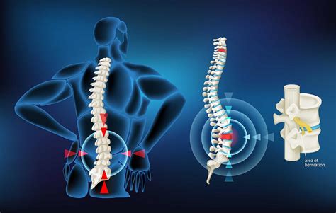 Herniated Disk Treatment At Sapna Spine And Pain Clinic Of North
