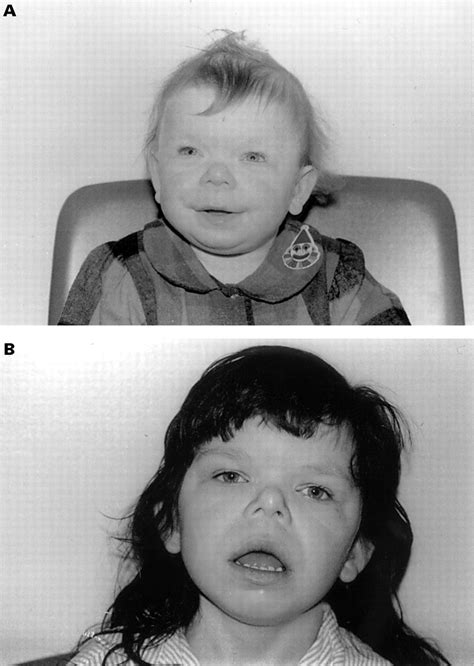 A Case Of Williams Syndrome With A Large Visible Cytogenetic Deletion