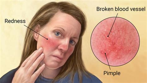 Red Flushed Face Symptoms