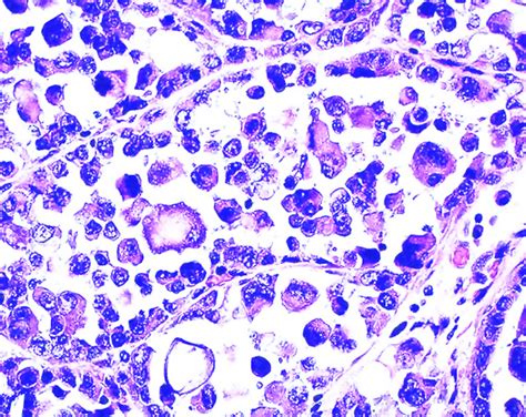 Pathology Outlines Alveolar Soft Part Sarcoma