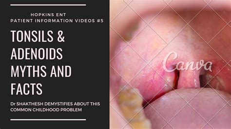 Tonsil And Adenoid Surgery Myths And Facts I Part Youtube