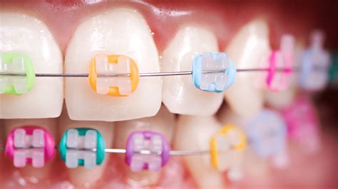 Colorful Braces Show Your Style And Have Fun Throughout Treatment