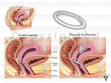 Stock Female Pelvis Prolapse Rectocele Cystocele — Illustrated Verdict