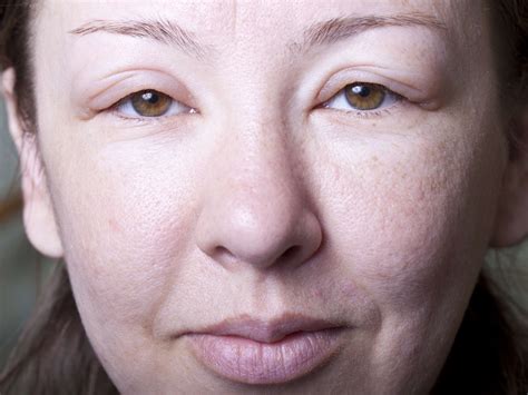 How To Reduce Face Swelling After Allergic Reaction Allergen 101