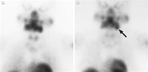 Appearance Of Ectopic Undescended Inferior Parathyroid Adenomas On
