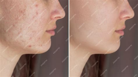 Premium Photo Cropped Shot Of Young Womans Face Before And After Acne