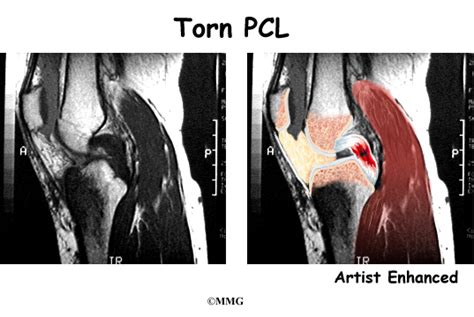 Posterior Cruciate Ligament Injuries Orthogate