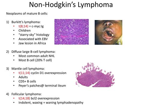 Is Diffuse Large B Cell Lymphoma Non Hodgkins