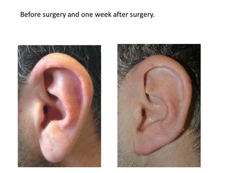 Earlobe Reduction Surgery Youtube