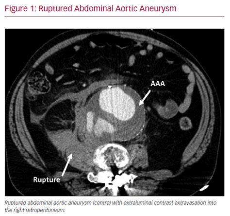 Ruptured Abdominal Aortic Aneurysm Radcliffe Vascular