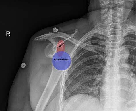 Anterior Shoulder Dislocation Radiology