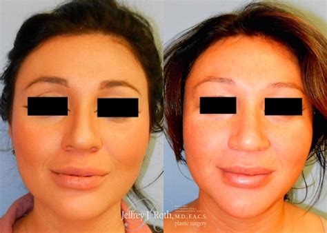 Dermal Fillers SHOCKING Transformation!