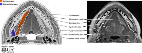 Imaging Of The Sublingual And Submandibular Spaces Springerlink