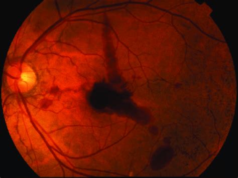 Macular Hemorrhage Complicating An Eye With Angioid Streaks Note The