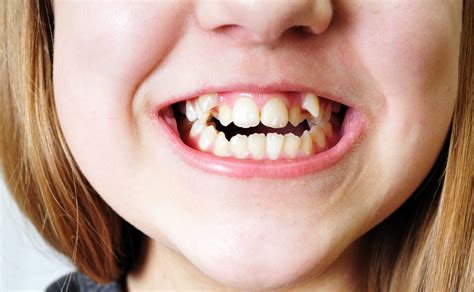 Brits Say Goodbye to the Bad British Teeth Myth | SymbeoHealth