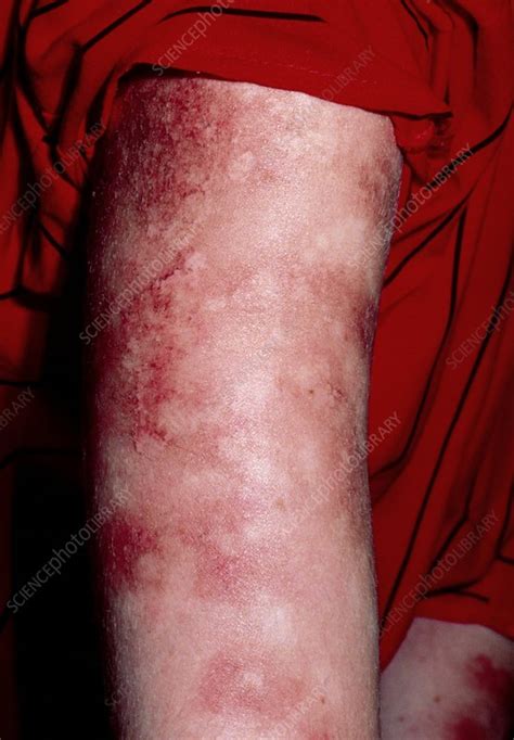 Skin Staining After Treatment Guttate Psoriasis Stock Image M240