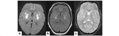 Brain Magnetic Resonance Image Mri Showed Abnormal Signal Intensity