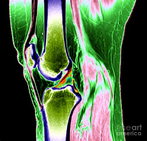 Normal Knee Photograph By Medical Body Scans Fine Art America