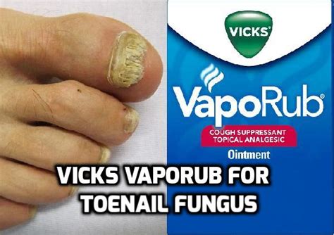 Vicks Vaporub For Toenail Fungus Health Melody