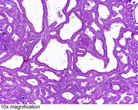 Pathology Outlines Tubulocystic Renal Cell Carcinoma