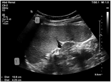 Sonographic Measurement Of Splenic Size And Its Correlation With Body