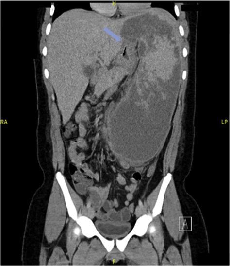 Coronal View Of Abdominal Ct Scan With Iv Contrast Showing Massive