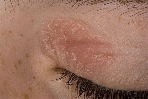 Rare Diseases And Rare Medicines Eczema Allergic Condition Of Skin