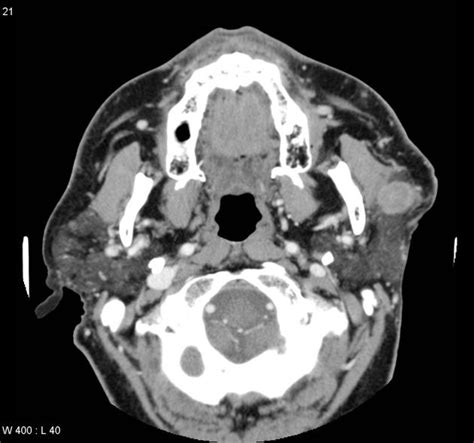 Salivary Gland Tumors Of The Parotid Gland Ct And Mr Imaging Findings