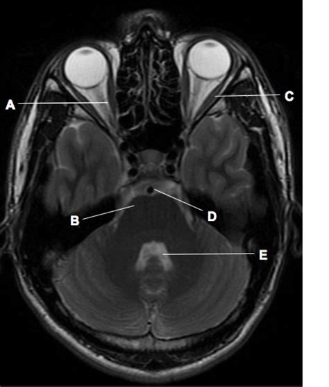 T2 Weighted Axial Magnetic Resonance Image Of The Brain The Bmj
