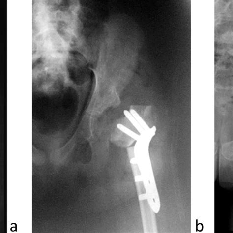 Ap Radiographs Of Patient Tims Left Hip Joint Febore Surgery A On