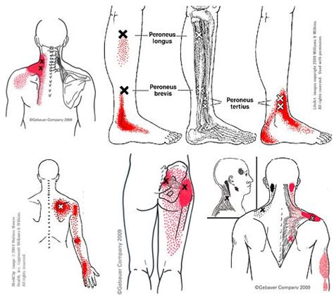 Pin By Mary Curry On Massage Therapy Trigger Points