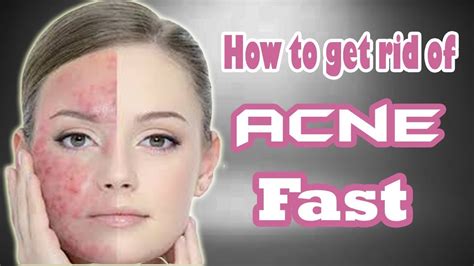 How To Get Rid Of Acne Fast How To Get Rid Of Acne Scars Youtube