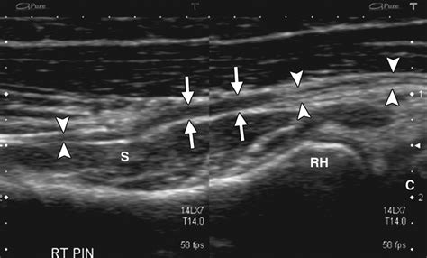 Multimodality Imaging Of Peripheral Neuropathies Of The Upper Limb And