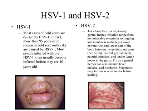 Herpes simplex is a common viral infection. Herpes Simplex 1 Genital — Herpes Free Me