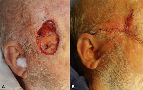 A Case Of Aggressive Squamous Cell Carcinoma With Lymphovascular