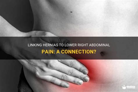 Linking Hernias To Lower Right Abdominal Pain A Connection Medshun