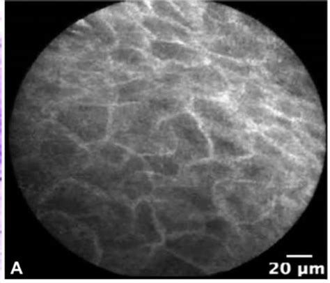 The Interstitium The Largest Organ We Never Knew We Had