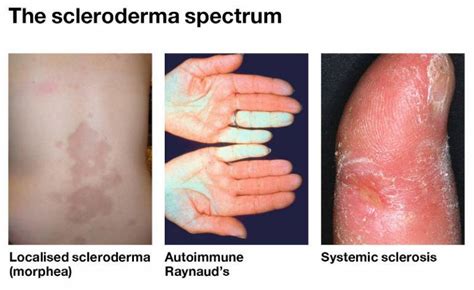 Systemic Scleroderma Hands