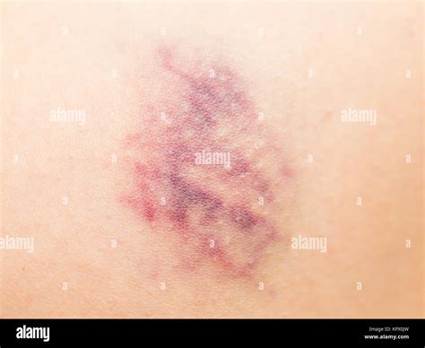 Skin Swollen High Resolution Stock Photography And Images Alamy